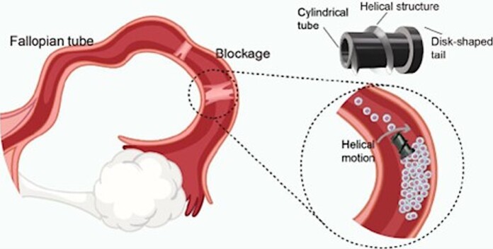 Robotic Screw Offers Hope for Treating Fallopian Tube Obstructions and Infertility